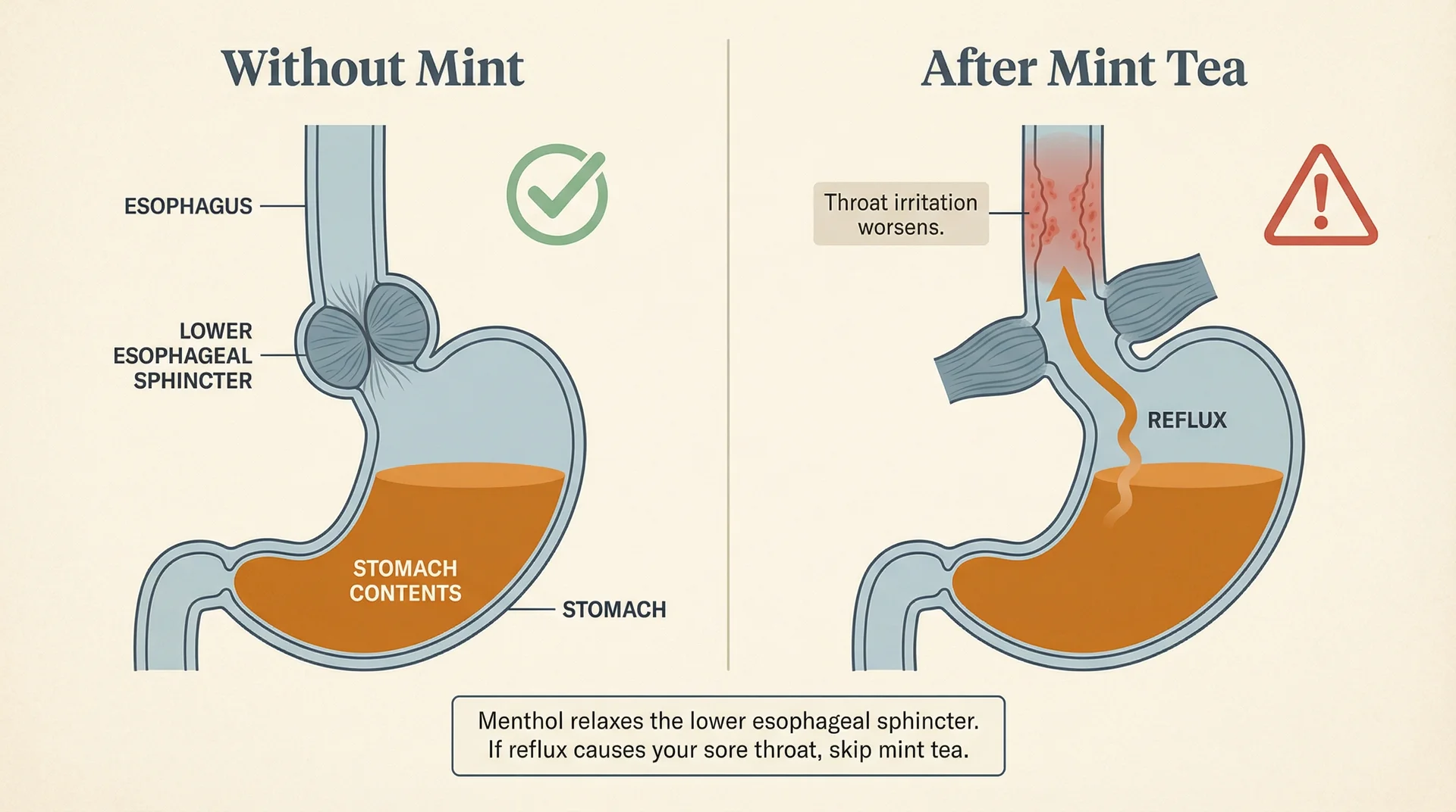 Anatomical diagram showing how menthol in mint tea relaxes the lower esophageal sphincter, allowing stomach acid to rise and worsen reflux-related sore throat
