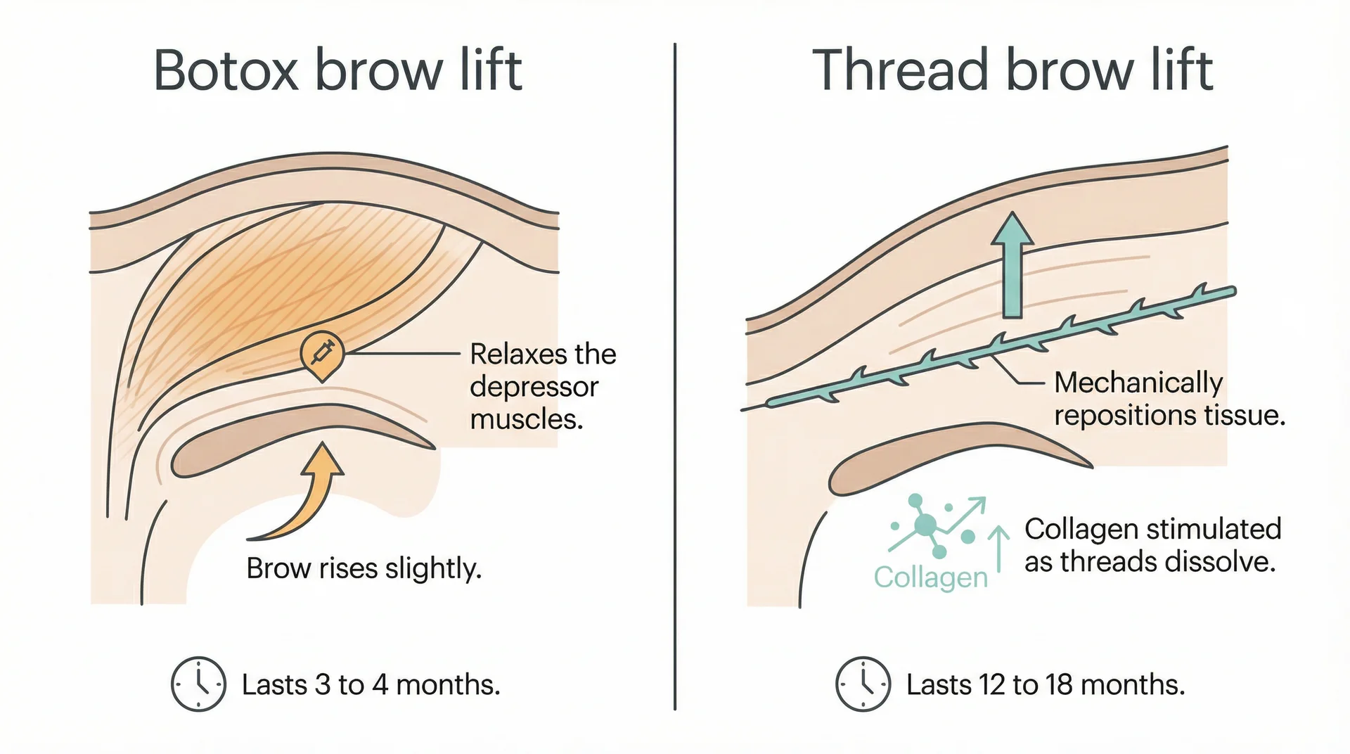 Comparison diagram showing how Botox relaxes brow muscles versus how PDO threads mechanically lift tissue
