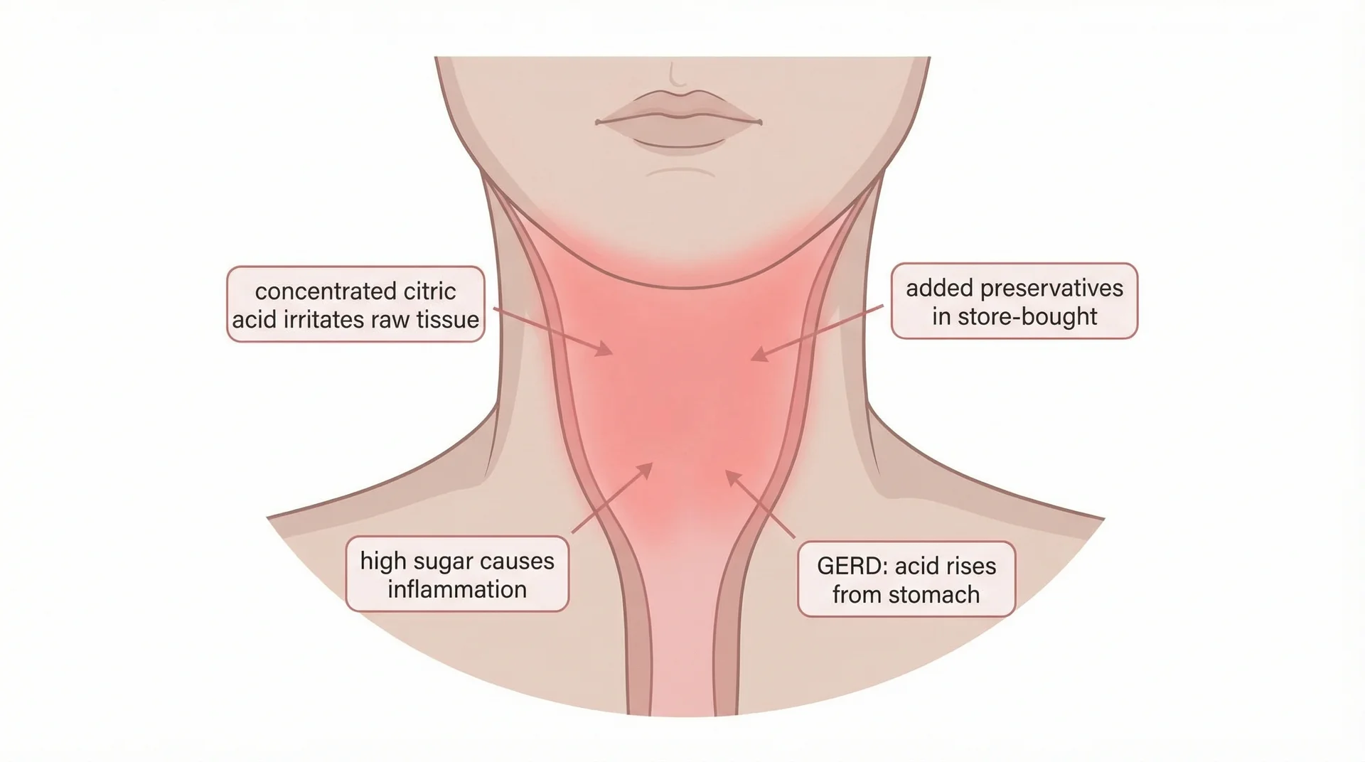 Diagram showing four reasons lemonade can worsen a sore throat including acid concentration and high sugar content