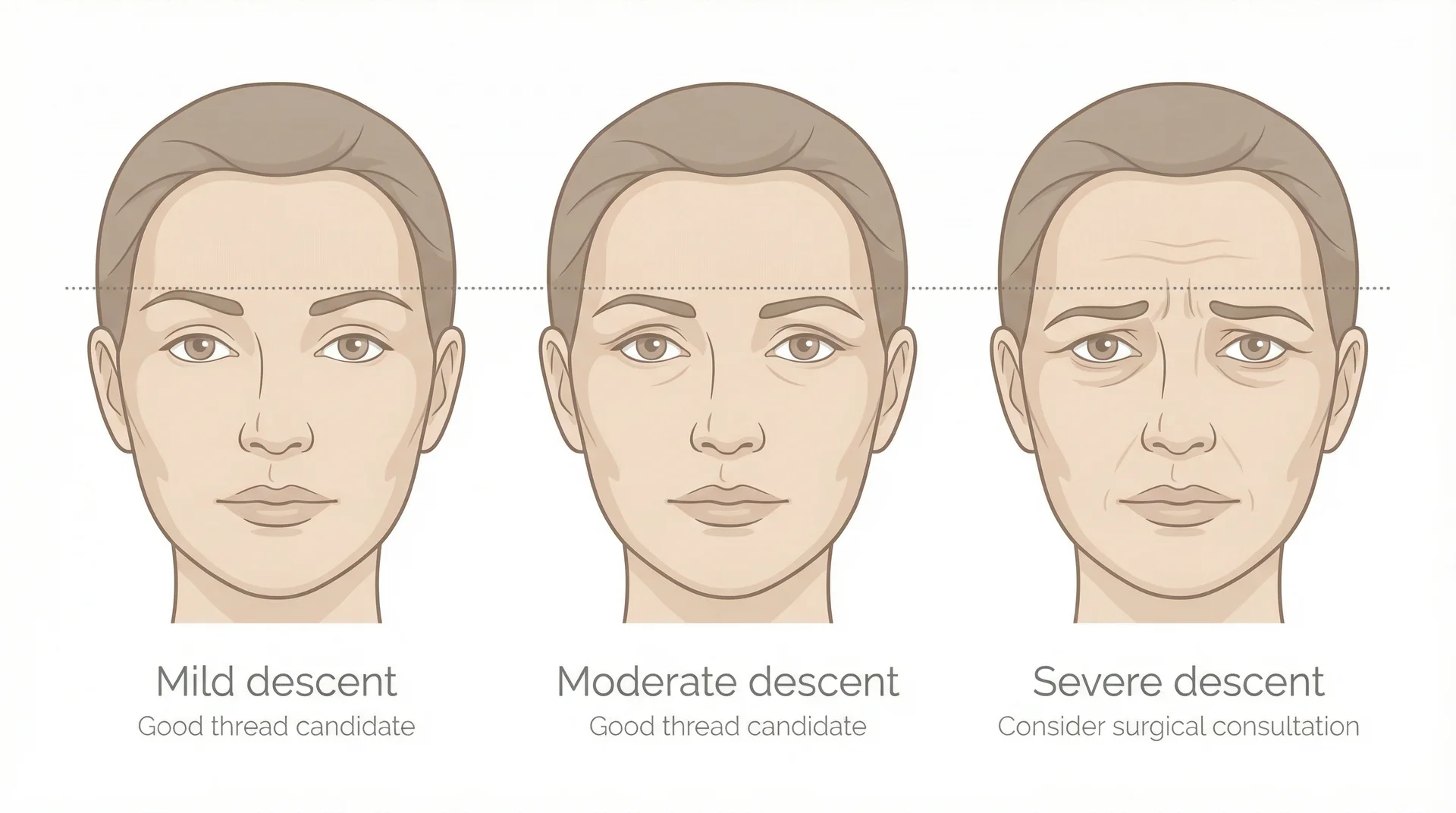 Illustration comparing mild, moderate, and severe brow descent to identify thread lift candidacy
